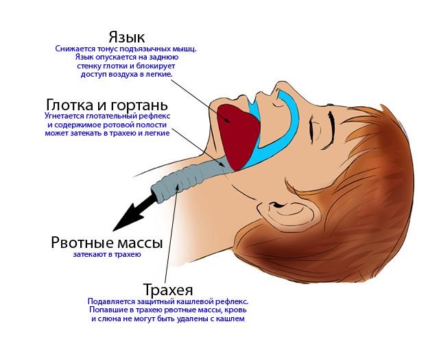 Процессы, которые происходят с дыхательными путями при потере сознания
